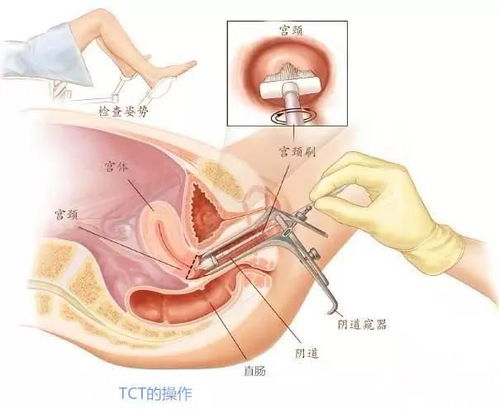 女子陪妹妹复查乳腺自己也查出癌症的步骤指南